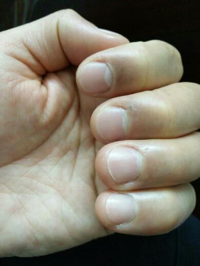 左手指甲的月牙消失,能看出哪里出问题吗?