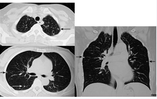 右肺纤维灶图片