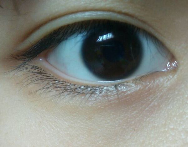 双眼皮宽1mm是不是太窄了一点?