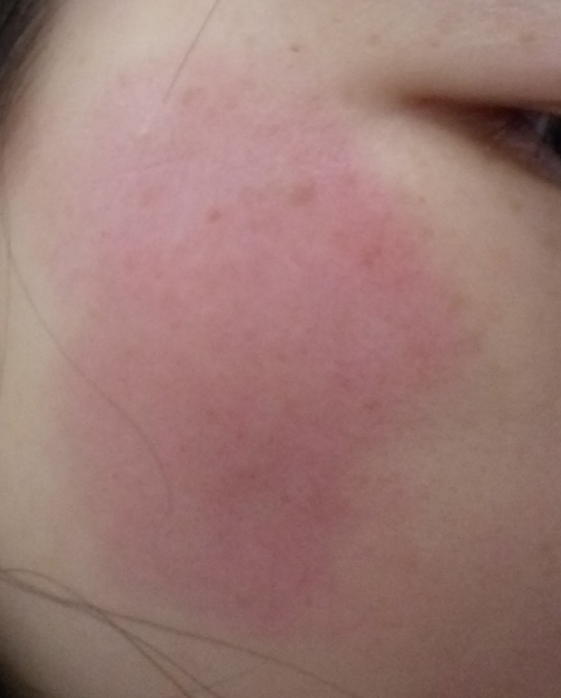 脸上红了一大块是怎么回事?有解决的方法吗?