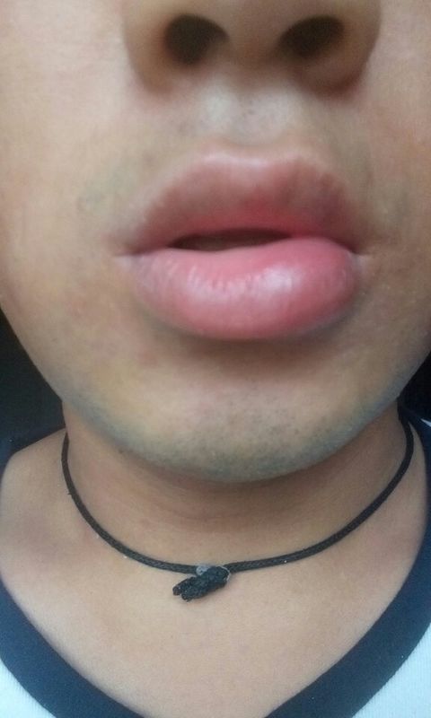 一醒来发现下嘴唇肿了,这是怎么回事? 睡觉的