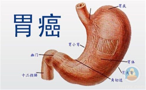 胃窦腺癌图片