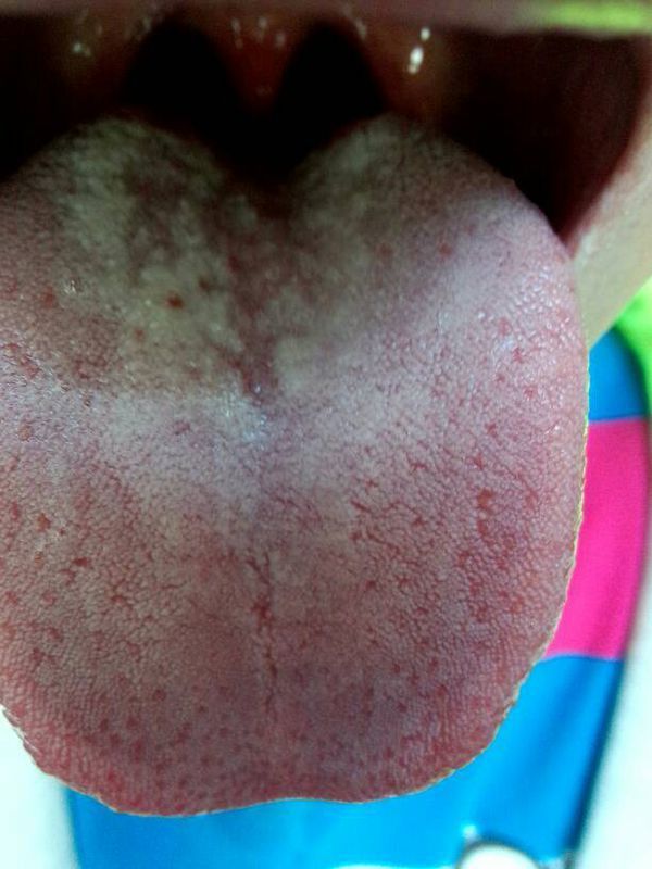 舌头根部溃疡图片