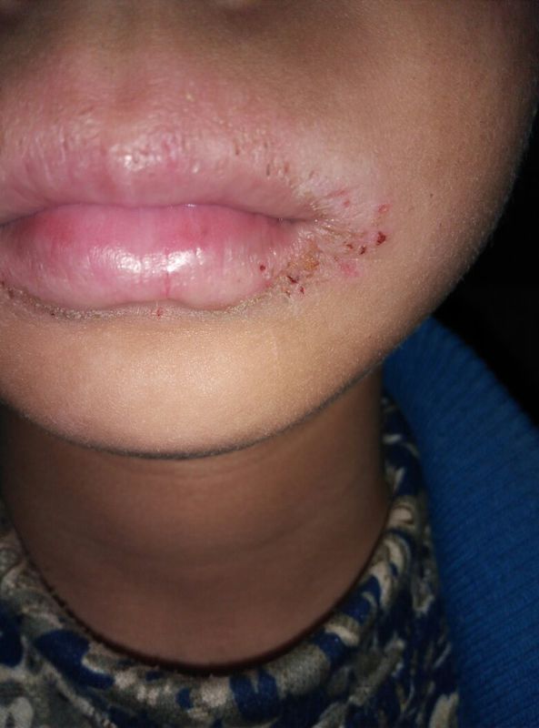 儿童嘴一圈烂了一年了,找过中医,说唇炎,没治好