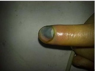 指甲板发黑是怎么导致的?