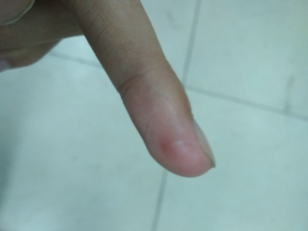 为什么手指被菜刀切到了,伤口愈合了大概一个