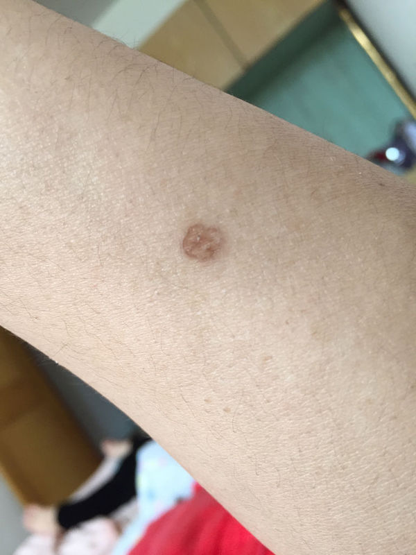 手上腿上长了几颗跟蜘蛛网似的的、去医院皮肤
