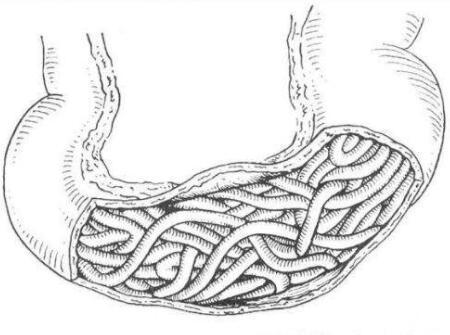 蛔虫性肠梗阻图片