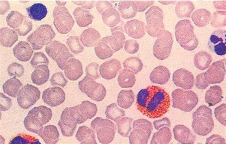 白血球高是怎么回事