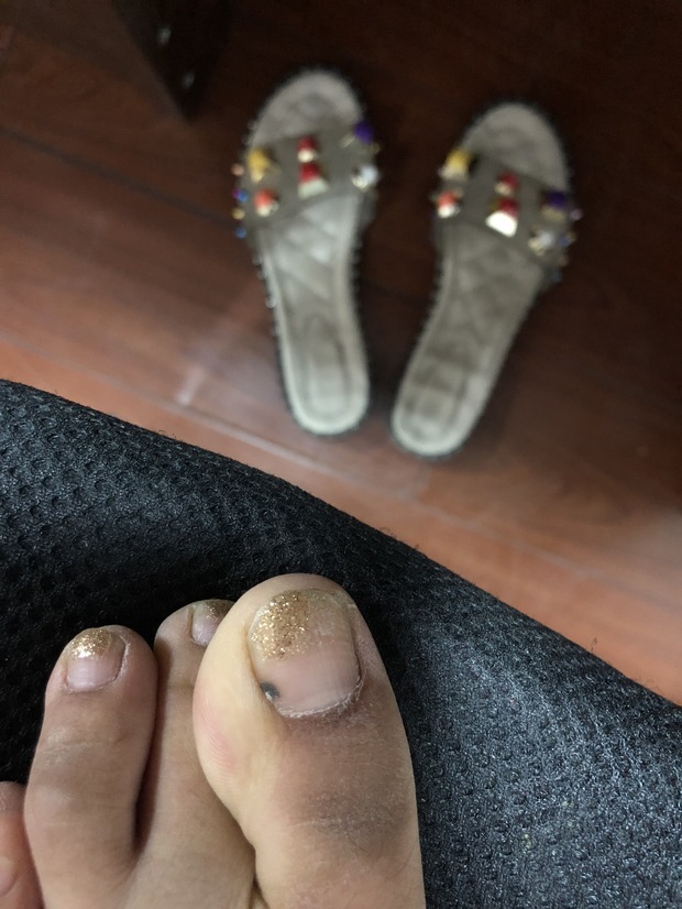 脚趾恶性黑色素瘤图片