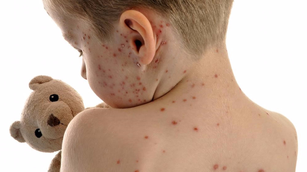  b>水痘 /b>患儿,家庭护理及 b>防治 /b>很重要,家长要做到这几点