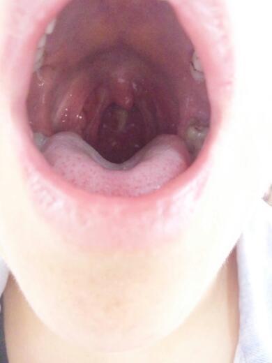 喉咙经常干,小舌下面常有痰粘着,痰比较粘稠,小