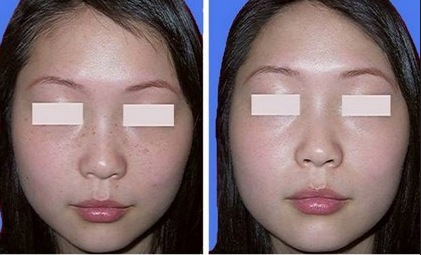 如何去掉脸上的斑,揭晓效果最好的祛斑方法