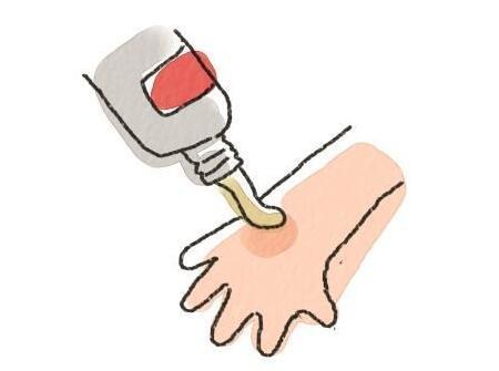 夏天宝宝烫伤的误区是什么 孩子烫伤后这些事情千万不要做