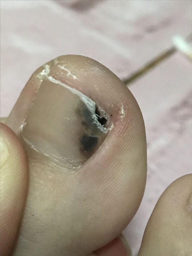 脚指甲黑了 然后把指甲壳给剪掉了 里面是黑色的硬硬的块状物 这是