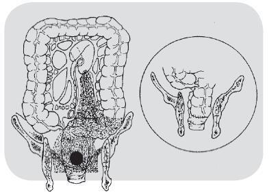 经腹直肠癌切除术(dixon 手术)范围与吻合示意图
