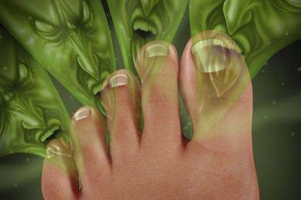 为什么有的人会得"香港脚"?