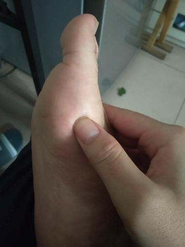 脚底大拇指关节处疼痛