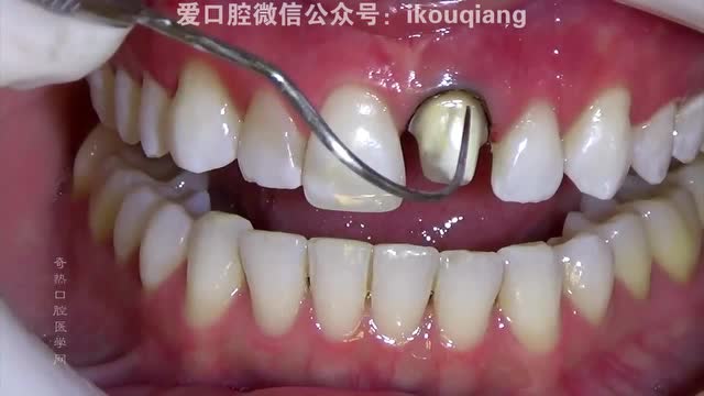 21牙体制备,排龈, 硅橡胶取模完整过程实拍