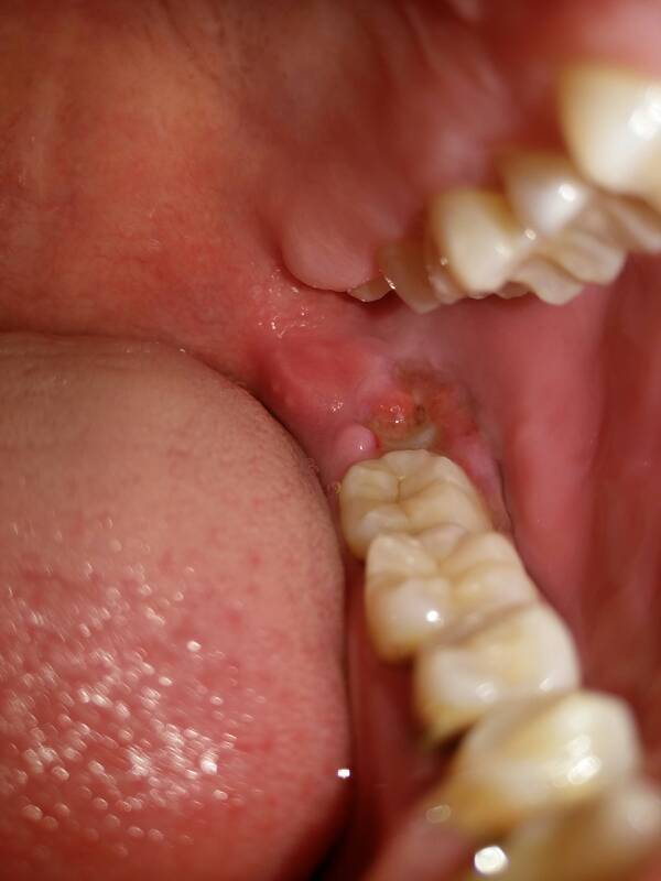 牙槽黏膜发炎图片
