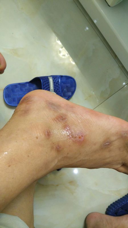 手上脚上都有,奇痒无比,抓破后会流水,之后会长厚皮