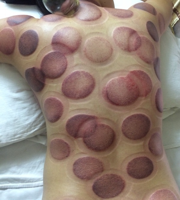 刚拔完火罐,我这个是什么情况?