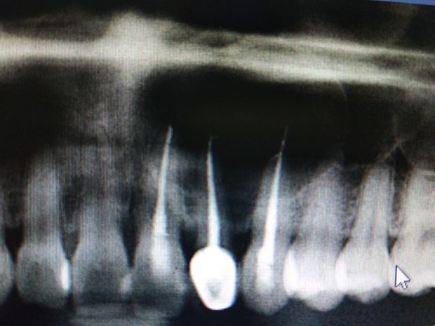 牙根尖囊肿手术是不是植入骨粉比较好