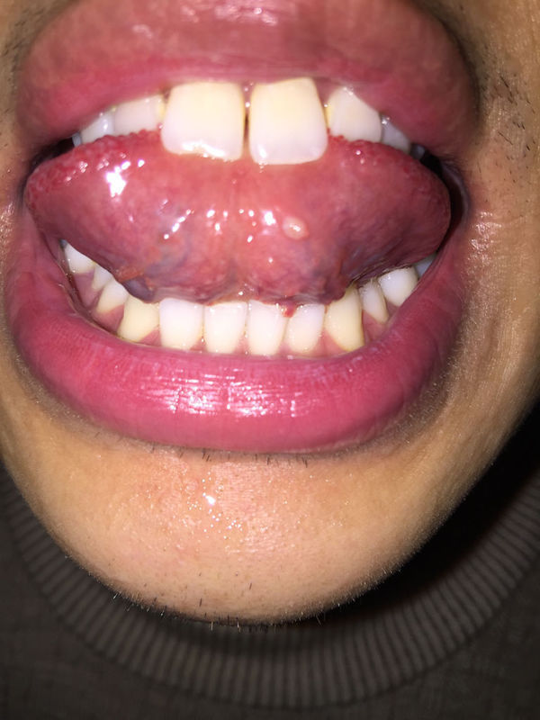 舌下腺发白图片