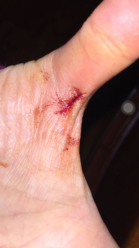 刚才不小心水果到切到手了 没生锈的不锈钢刀 请问用不用打破伤风针?