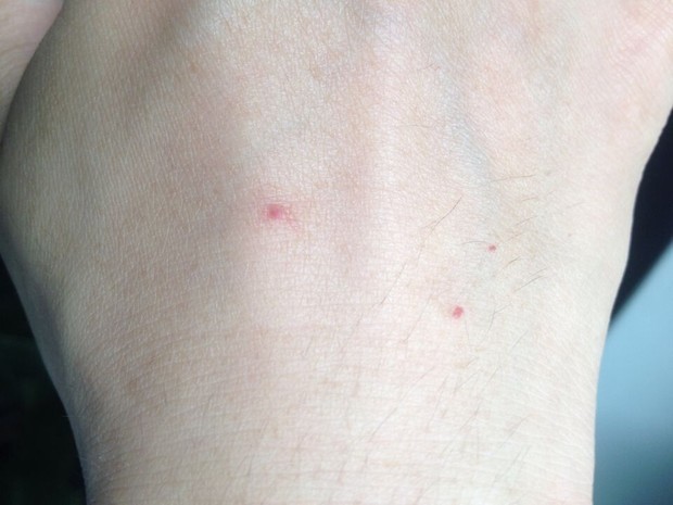 我手上长有红色的小血点,主要表现以下几点: 1,可以看到红色小点中的