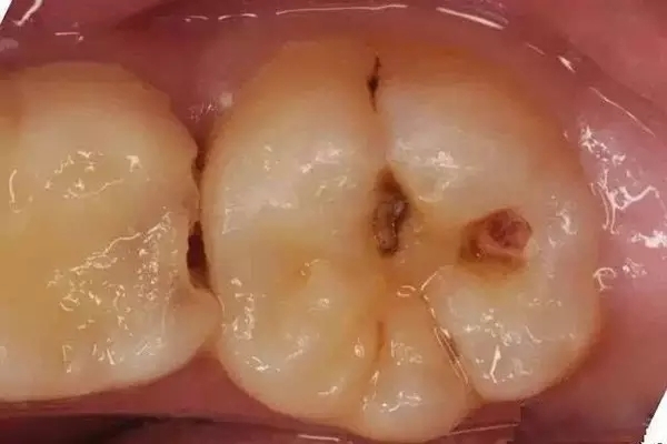 如果虫牙一直不去治疗,会有什么样的后果?