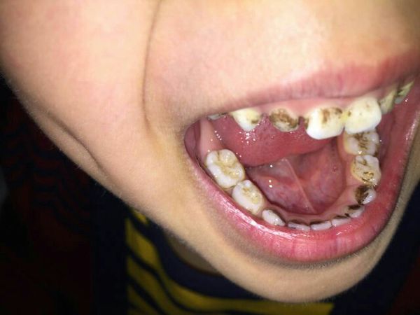 小孩换牙牙龈发黑图片图片