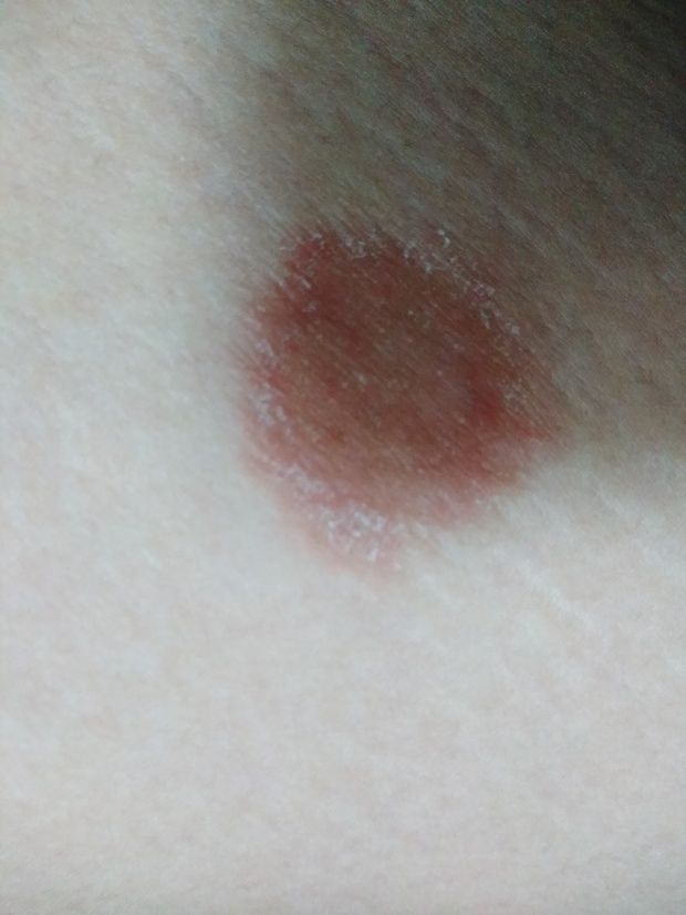 大腿内侧膝盖到腿根2\/3处,突然出现红斑,表面粗