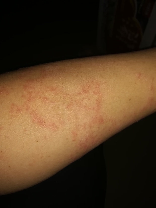 两个胳膊上起了很多小红疙瘩,有时痒痒有时不