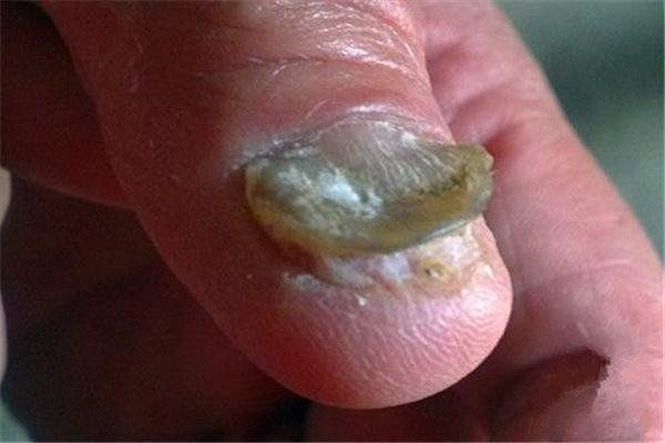 得了灰指甲,一个传染俩,灰指甲的病理特征是什么?