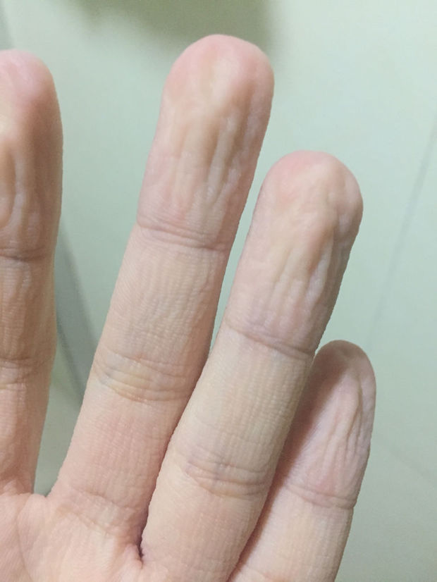我的手为什么湿水容易皱皮,只要洗手几分钟后,就皱皮了.
