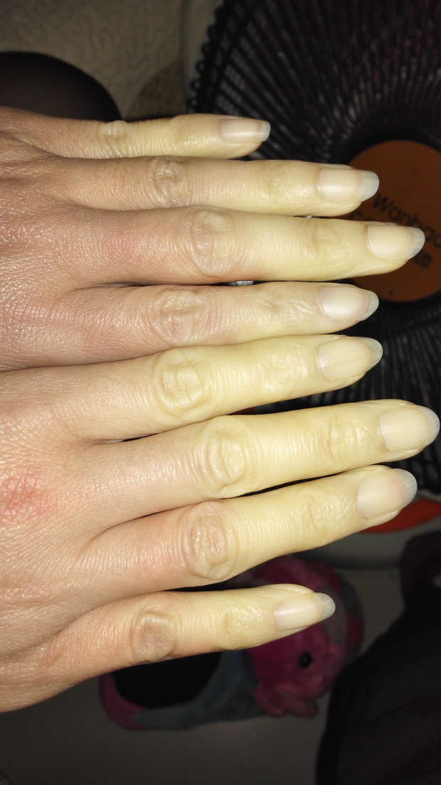 女朋友冷天手脚发冷变白