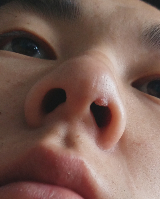 我鼻孔上长了一个类似刺猴或扁平疣或寻常疣的东西,好几个月了,以前手