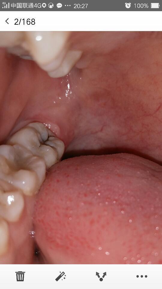 最后面鼓牙特别疼吃布洛芬也不管用!