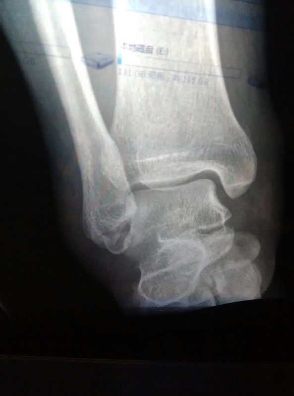 脚踝斯托性骨折,医生说可以保守治疗,没动手术