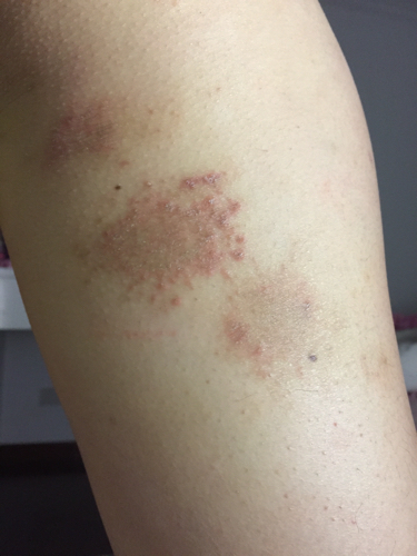 腿后面 开始是像蚊子咬又像水泡痒痒的一粒粒