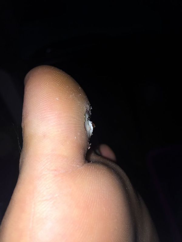 贴了一周鸡眼贴,清理掉四周的死皮中间凸起了一小块肉.触碰有痛感.