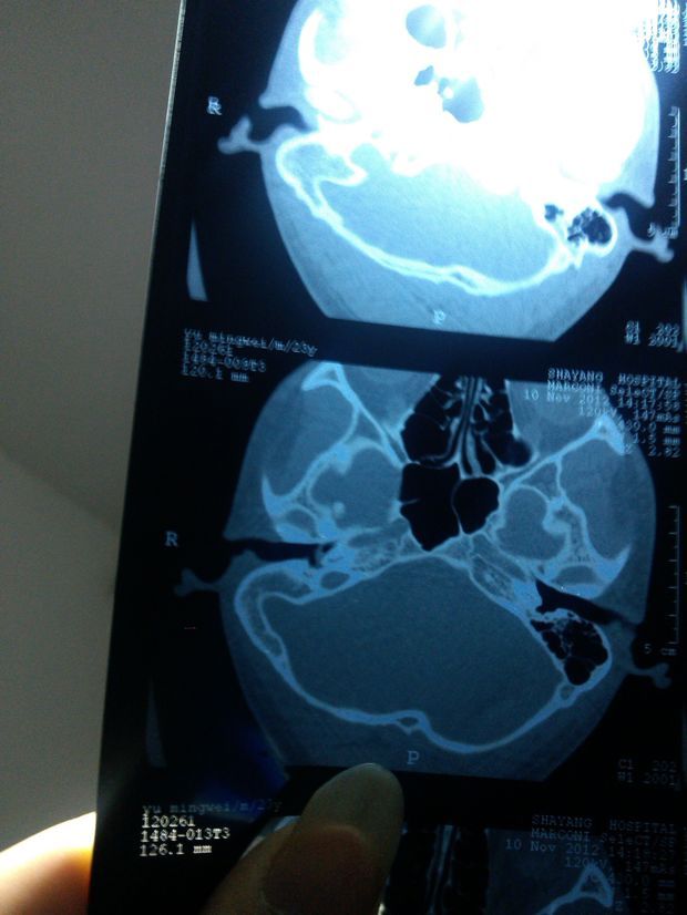 耳部ct图片
