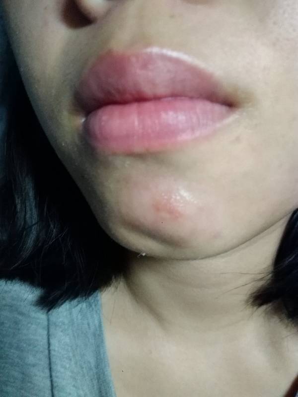 突然下巴就肿了一大块,昨天发的,开始以为是闷着的痘痘,今天晚上突