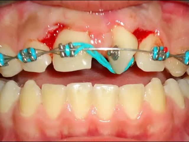 门牙扭转 矫正的真实过程!
