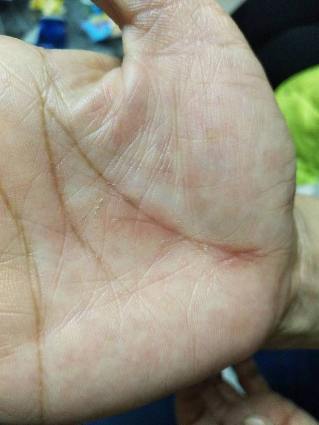 过敏体质手痒,有两年了,最近严重了,在医院查过过敏源说蘑菇和屋尘