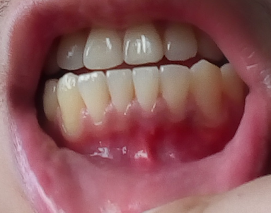 看一下我这是牙龈萎缩,下面牙龈比较薄