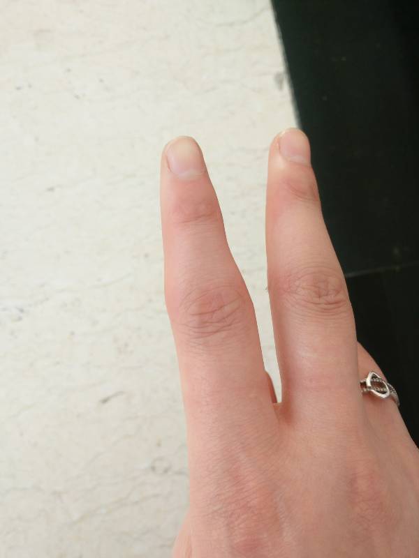 生冻疮好后手指骨头都变粗了,怎么办,怎么才能恢复到