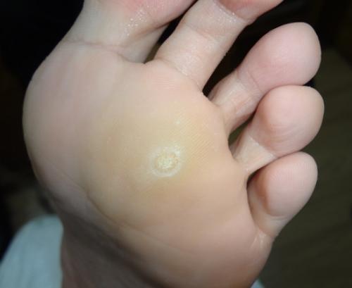 脚上长了鸡眼怎么除掉