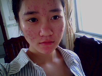 我姐姐10月5日结婚我这一脸痘痘怎么办啊在线求解决!